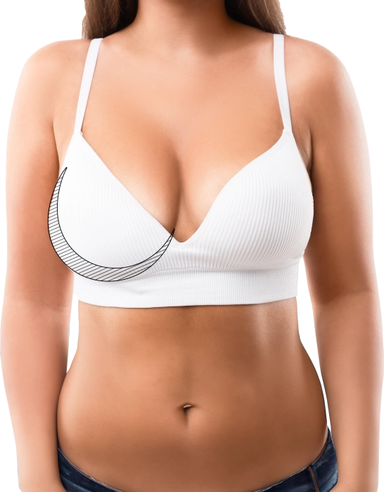 Breast Reduction Surgery