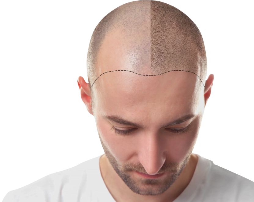 DHI-Haartransplantation