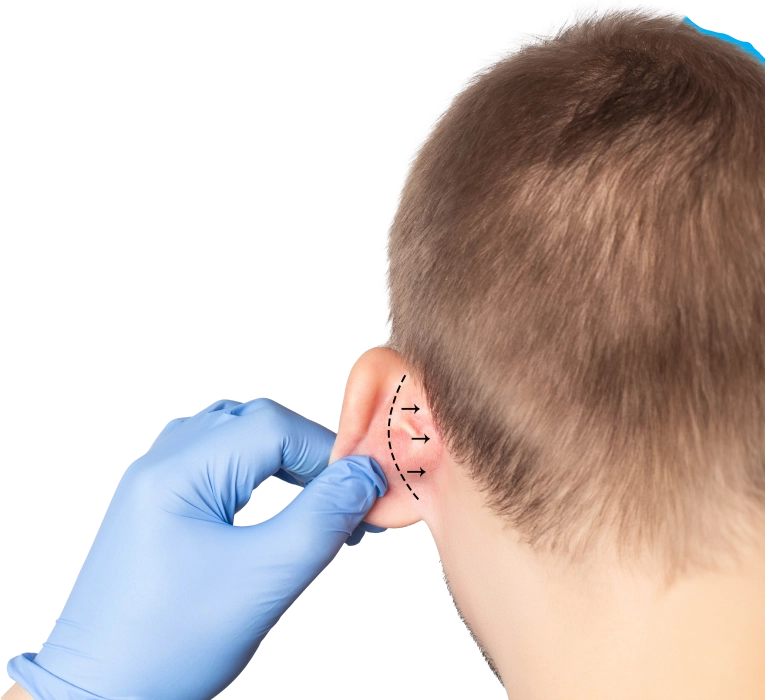 Otoplasty Surgery